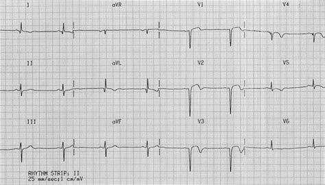 Left Ventricular Aneurysm • LITFL • EC.